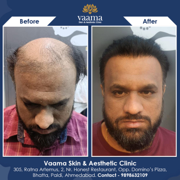 Hair Transplant Results in 6 months