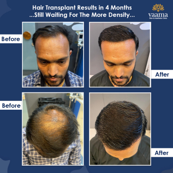 Hair Transplant Results in 4 months