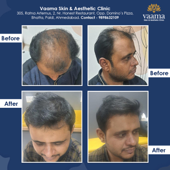 Hair Transplant Results in 6 months