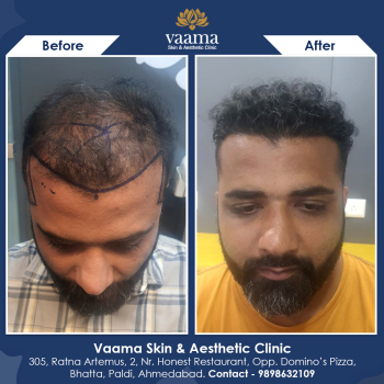 Hair Transplant Results in 6 months