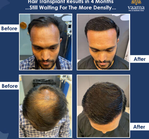 Before-After-08-Density